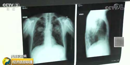 關(guān)注職業(yè)病 我國職業(yè)病中近九成是塵肺病